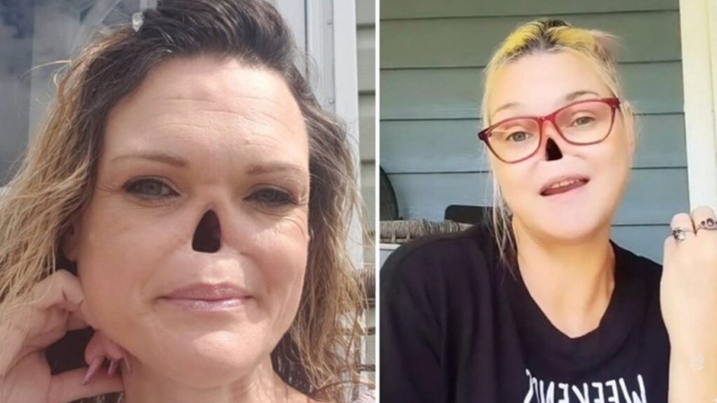 EstA mulher teve o seu nariz removido por causa de uma simpl… Ver MaiS!!