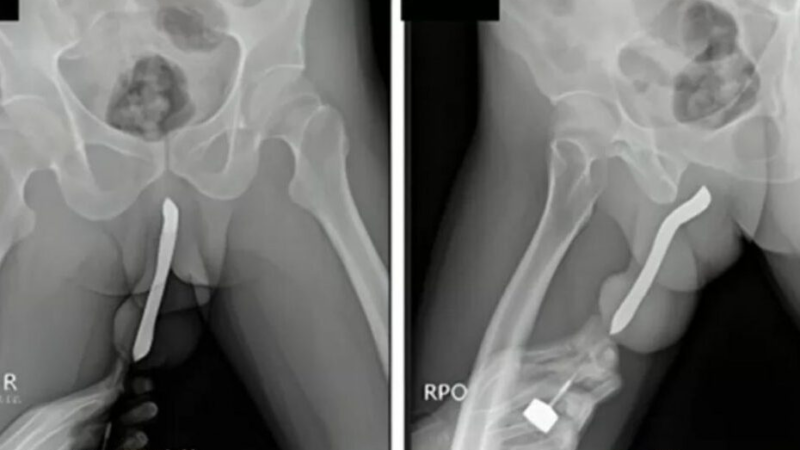 Homem vai parar no hospital por motivo inusitado; objeto quebrou e….v3ja mais