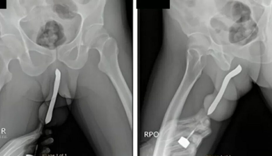 Homem vai parar no hospital por motivo inusitado; objeto quebrou e….v3ja mais